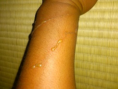 クラゲに刺されて水ぶくれ